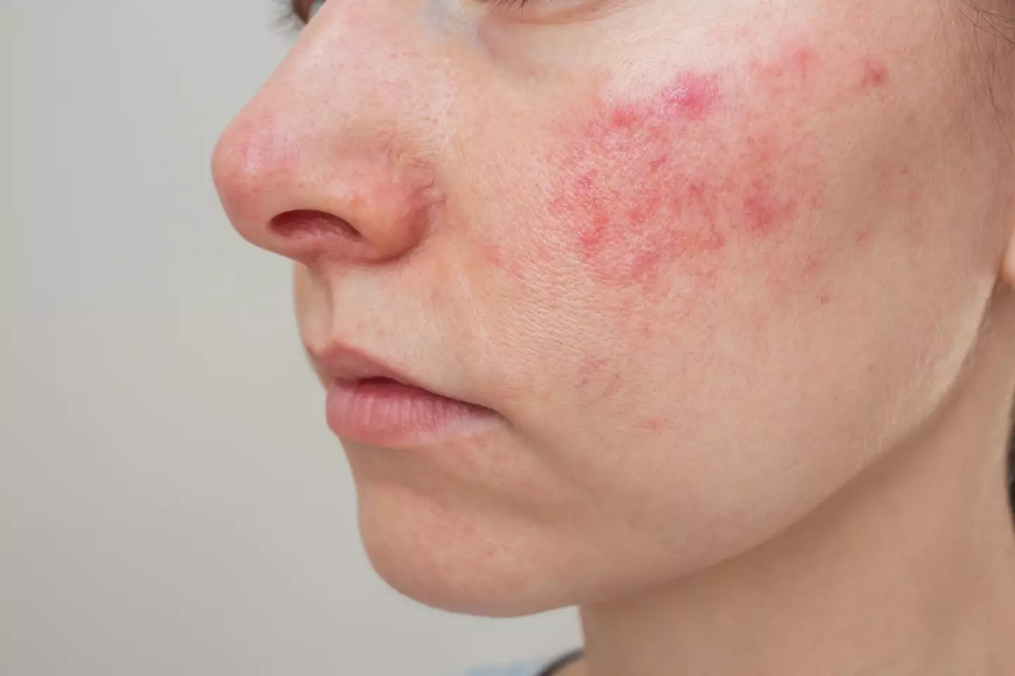 Rosacea has been linked in some cases to liver issues (Getty Stock)