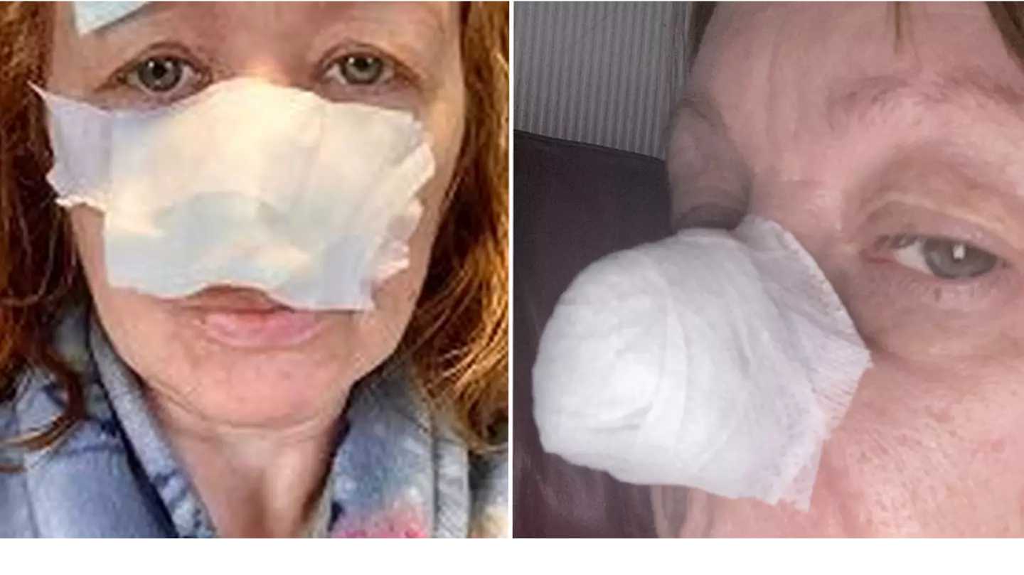 Mum loses chunk from nose after spot dismissed by doctors turned out to be cancer