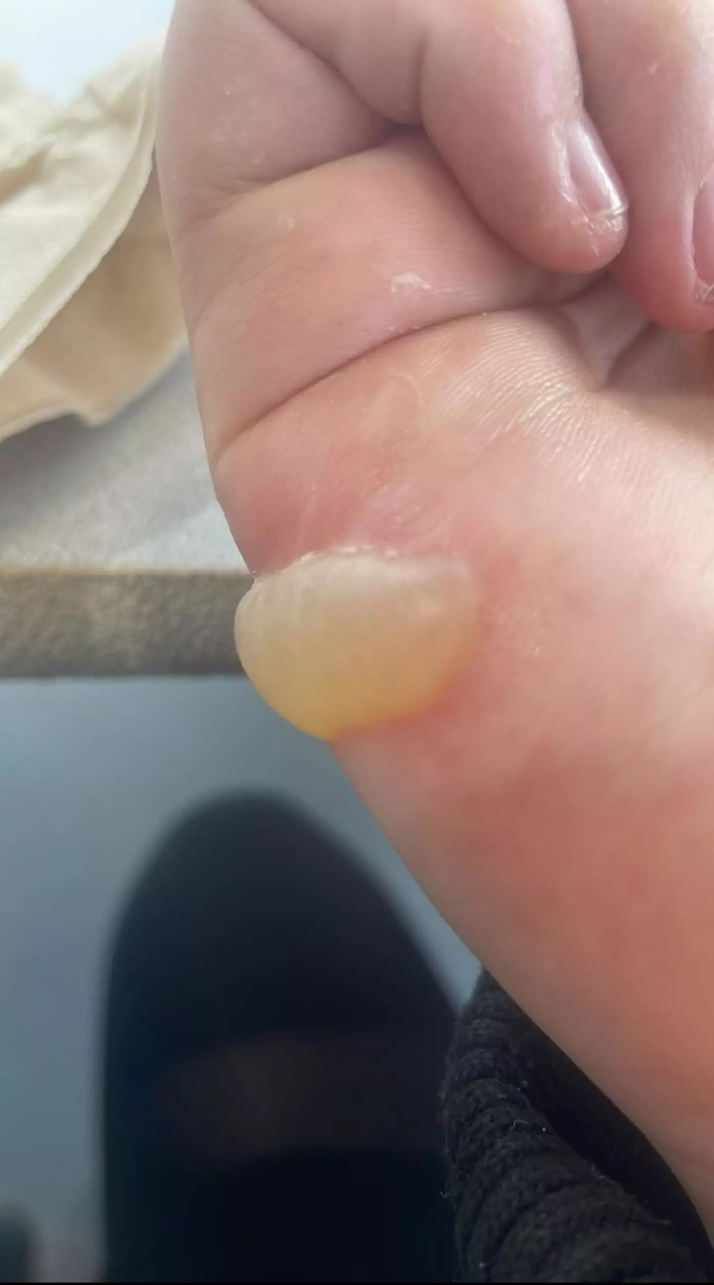 Chloe's blisters reached 'about 6 cm in length'.