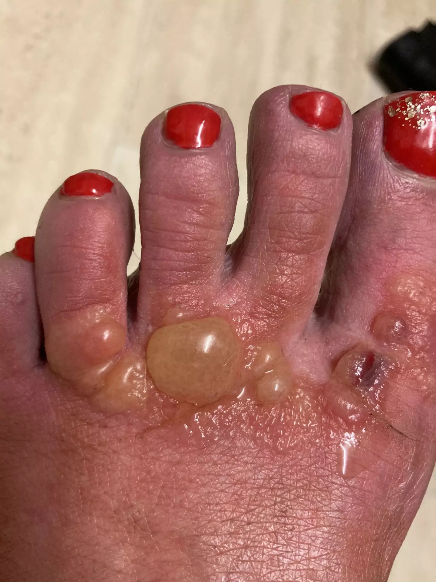 Painful boils and welts erupted (