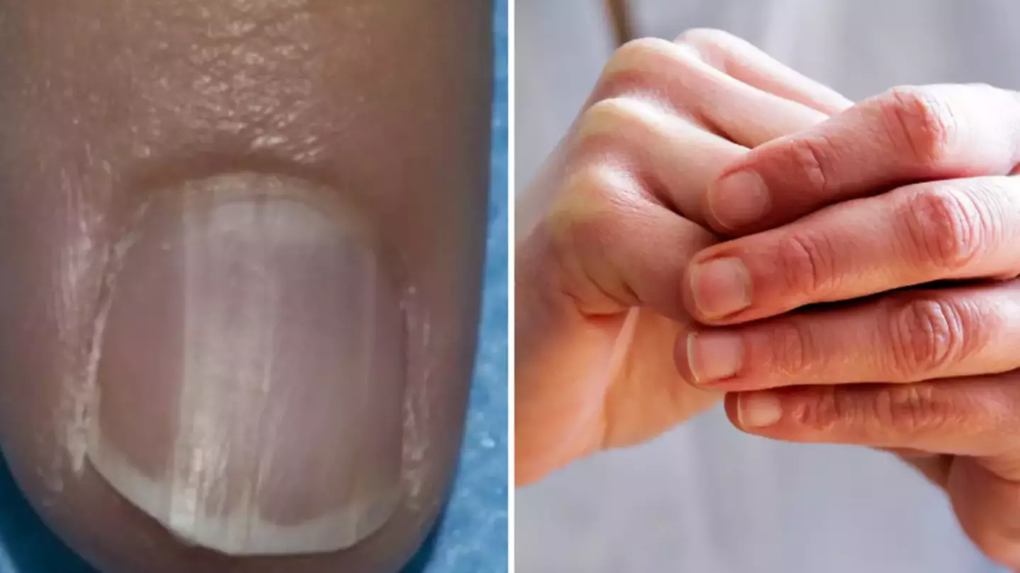What to look out for after experts issue warning on ‘nail abnormalities’ linked to cancer