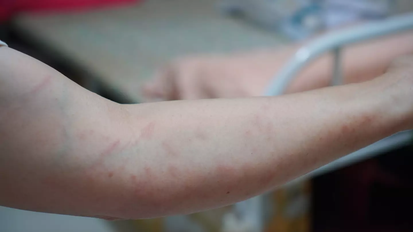 Rare illness spreading across US that causes meat allergy has sparked warning from officials