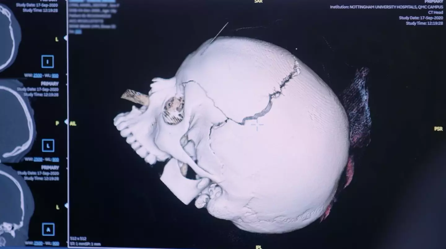 Angel's injury was 'so devastating' that doctors thought she might not survive.