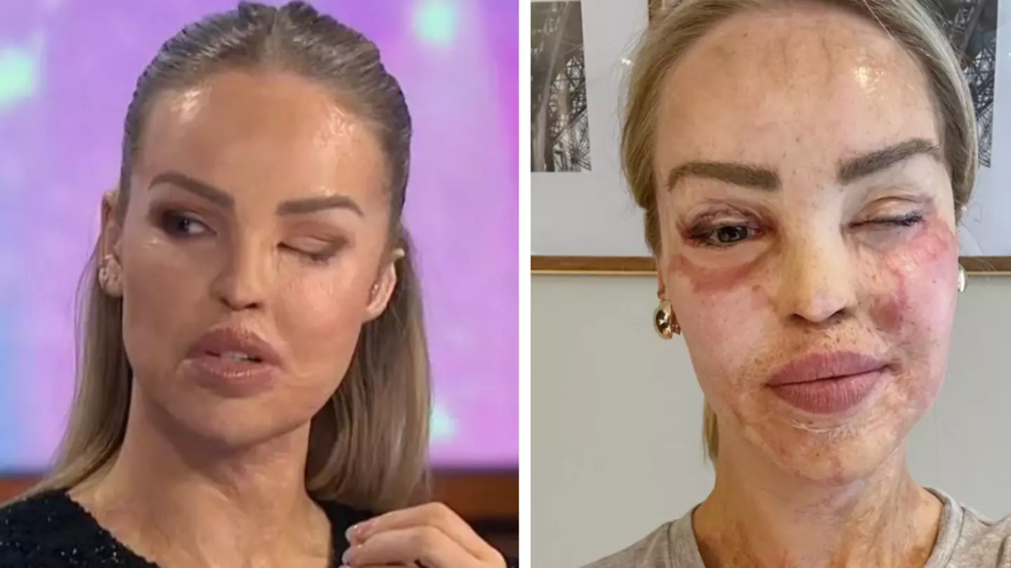Katie Piper shares update after her eye is sewn shut for a year