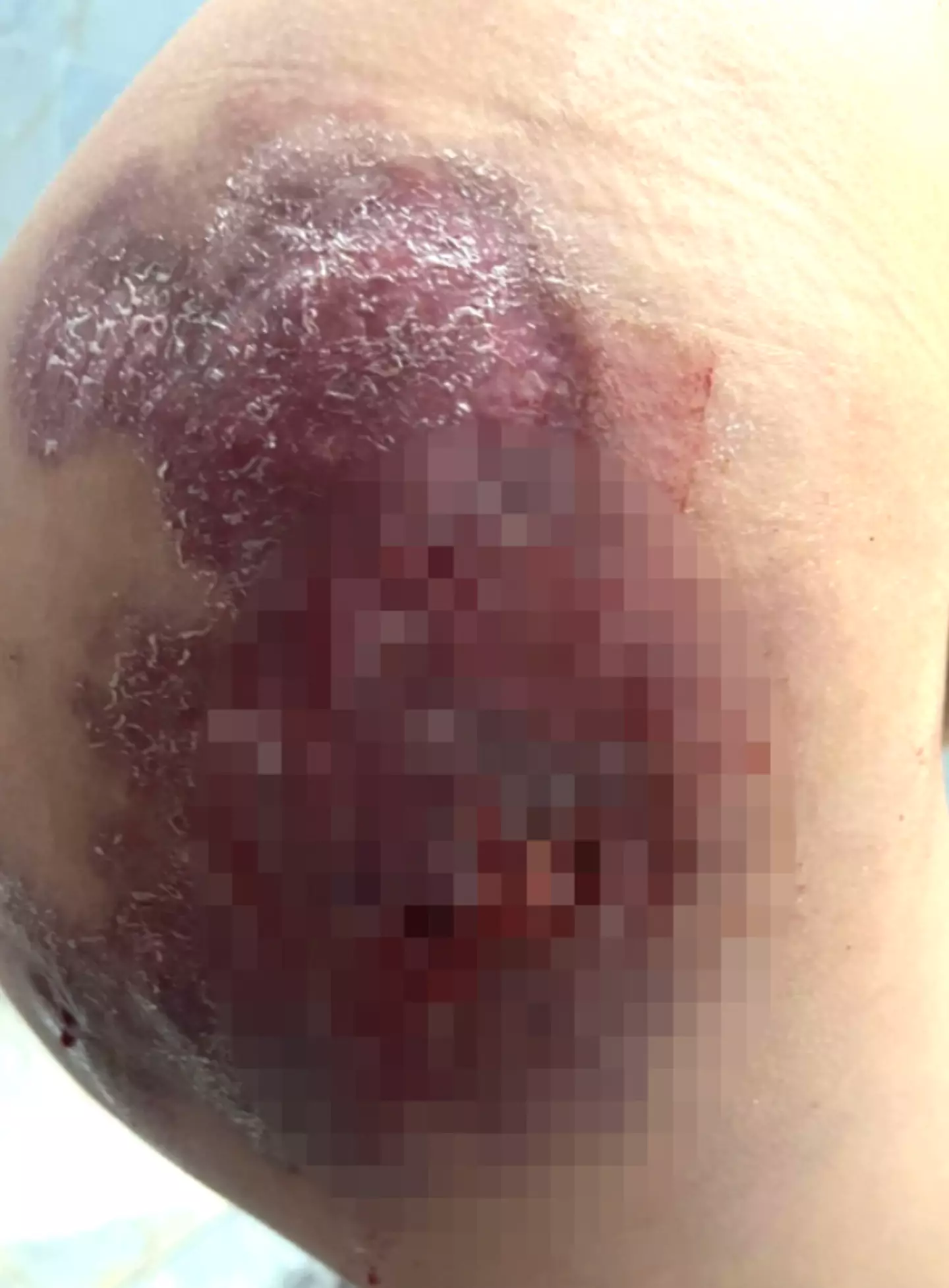 She had developed sepsis.