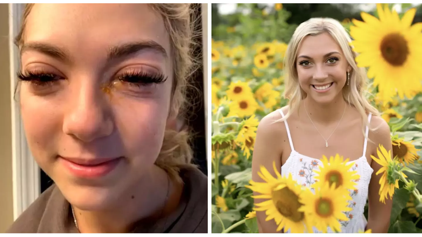 Woman left looking like a 'zombie' after horror allergic reaction to lash extensions