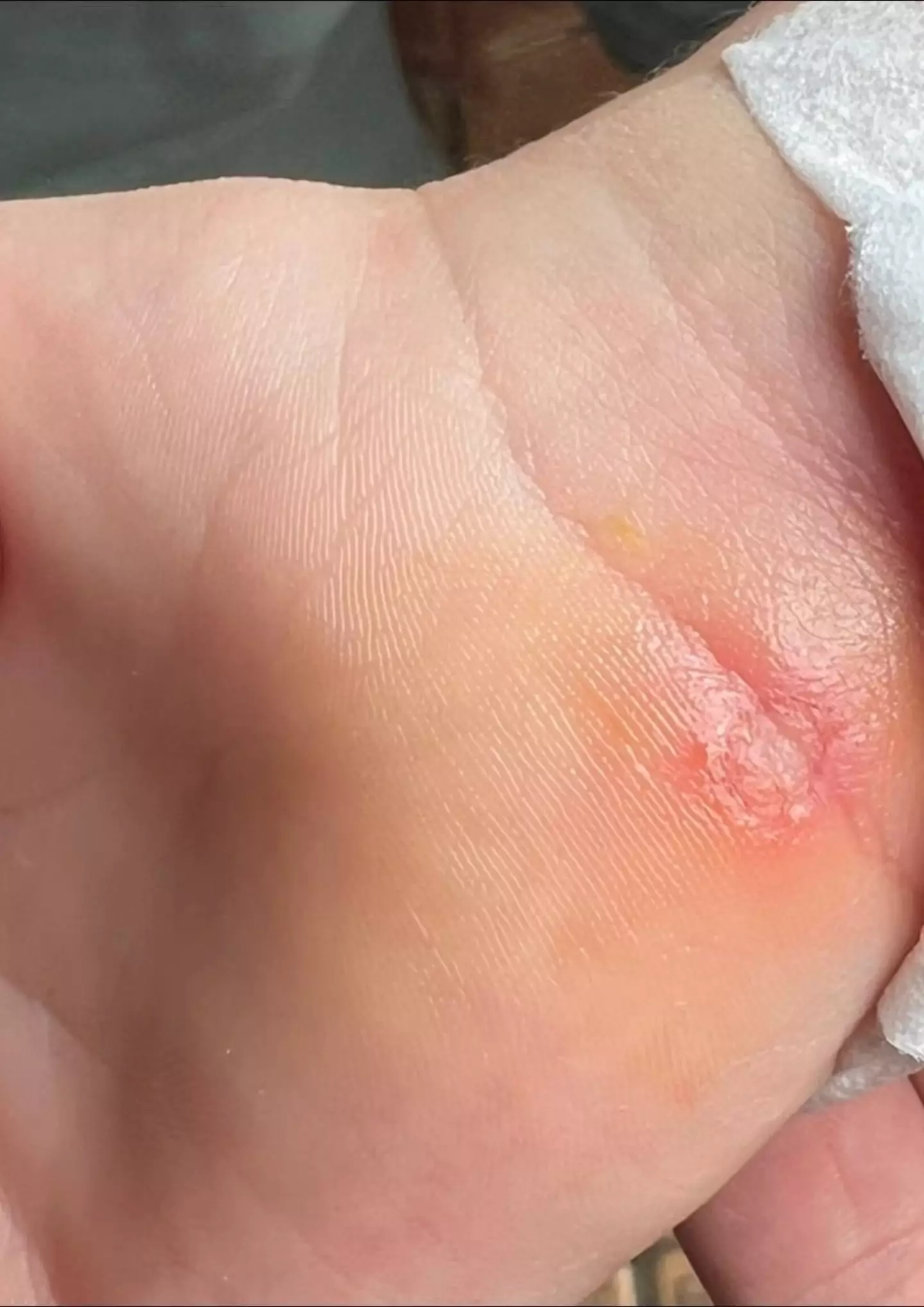 One mum warned other parents to keep an eye out after her daughter caught a lymph infection.