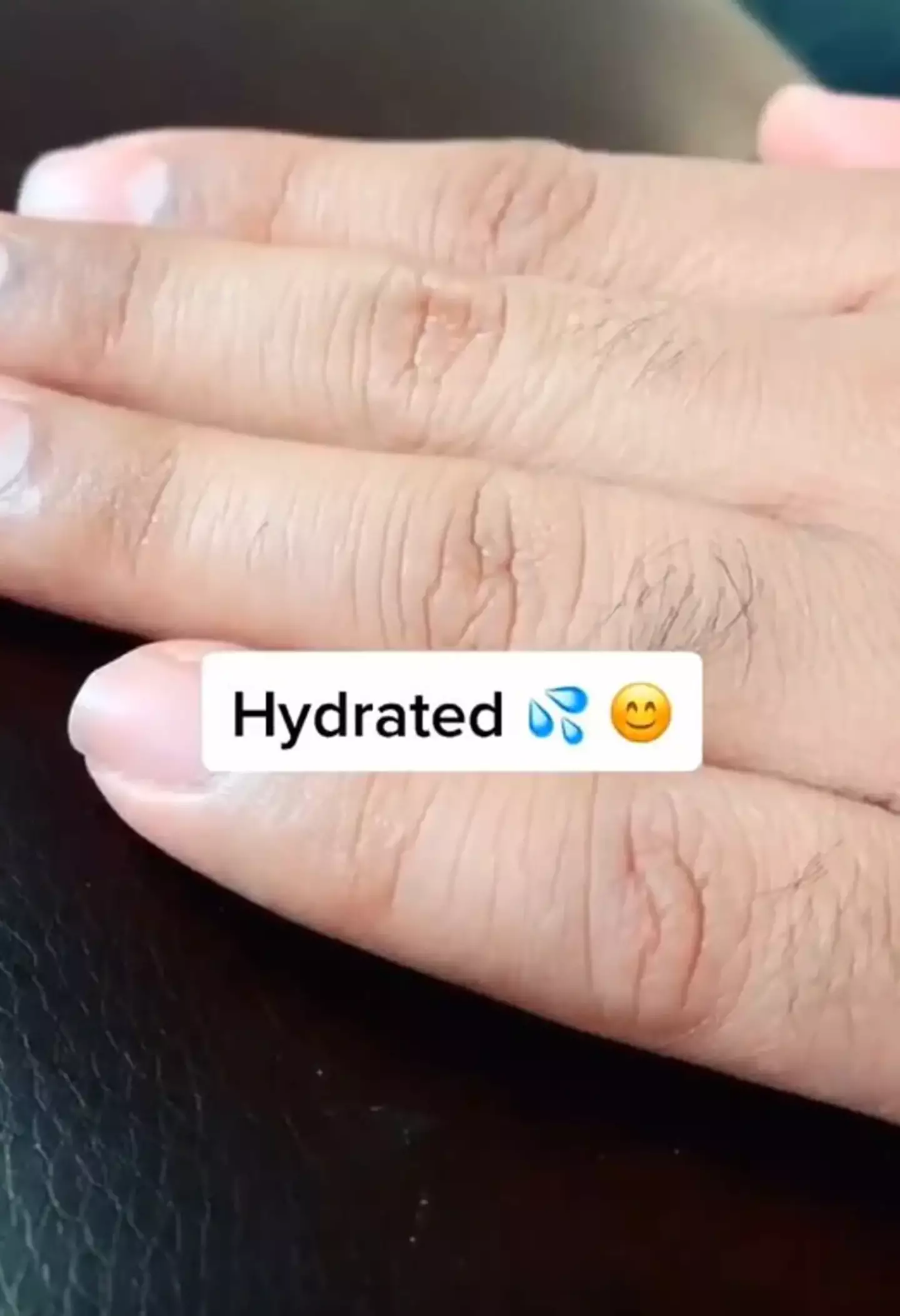 A hydrated hand.