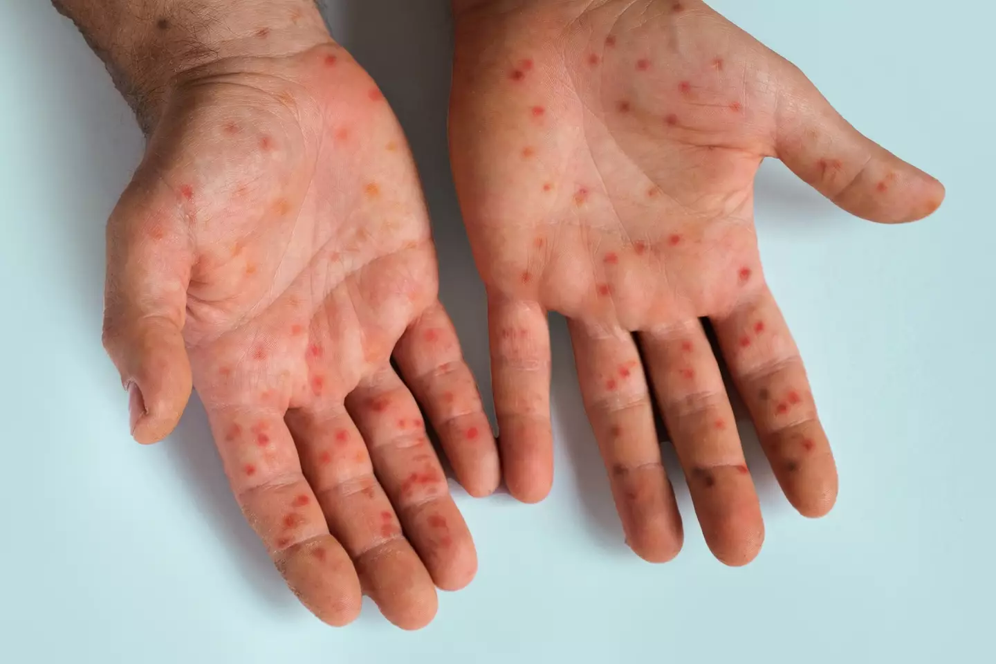 Mpox is a viral infection which causes pox-like legions. (Getty Stock Images)