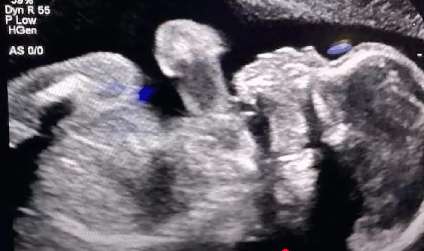 Doctors plan to induce the brain-dead woman, who is currently at 21 weeks, at 32 weeks along in her pregnancy (11 Alive)