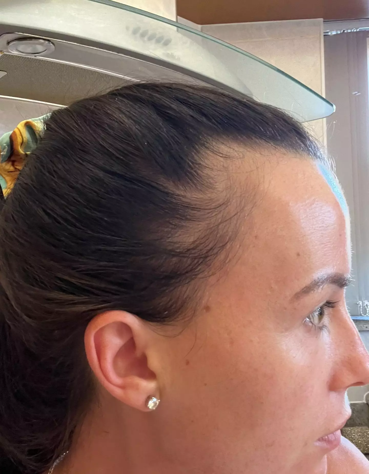 Billie's hair before the transplant. Kennedy News