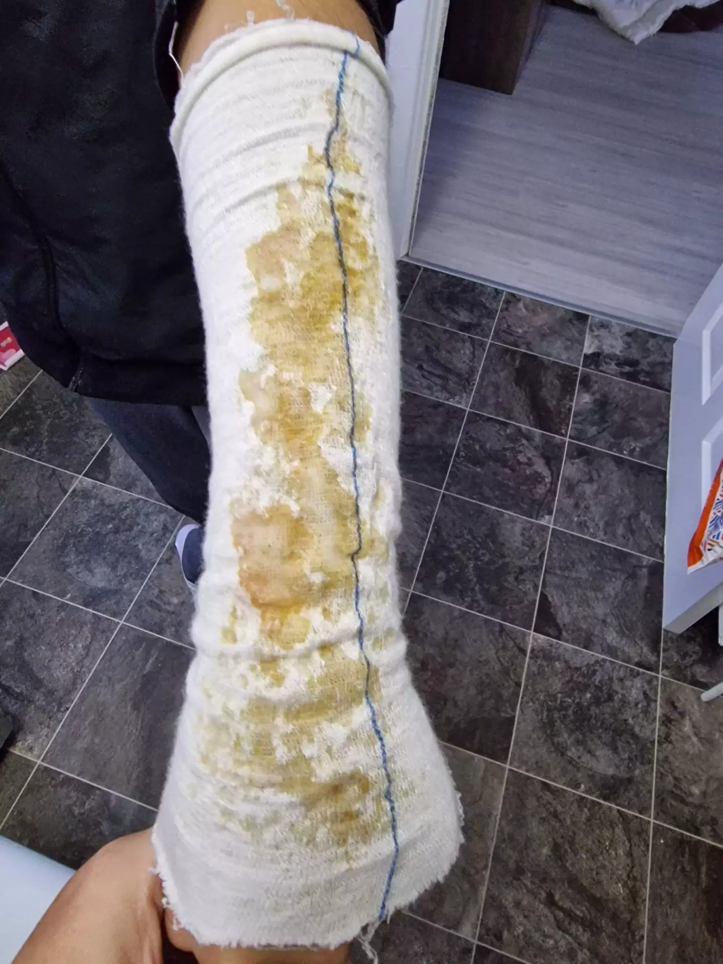 The youngster's burn began weeping through his bandages and clothes.