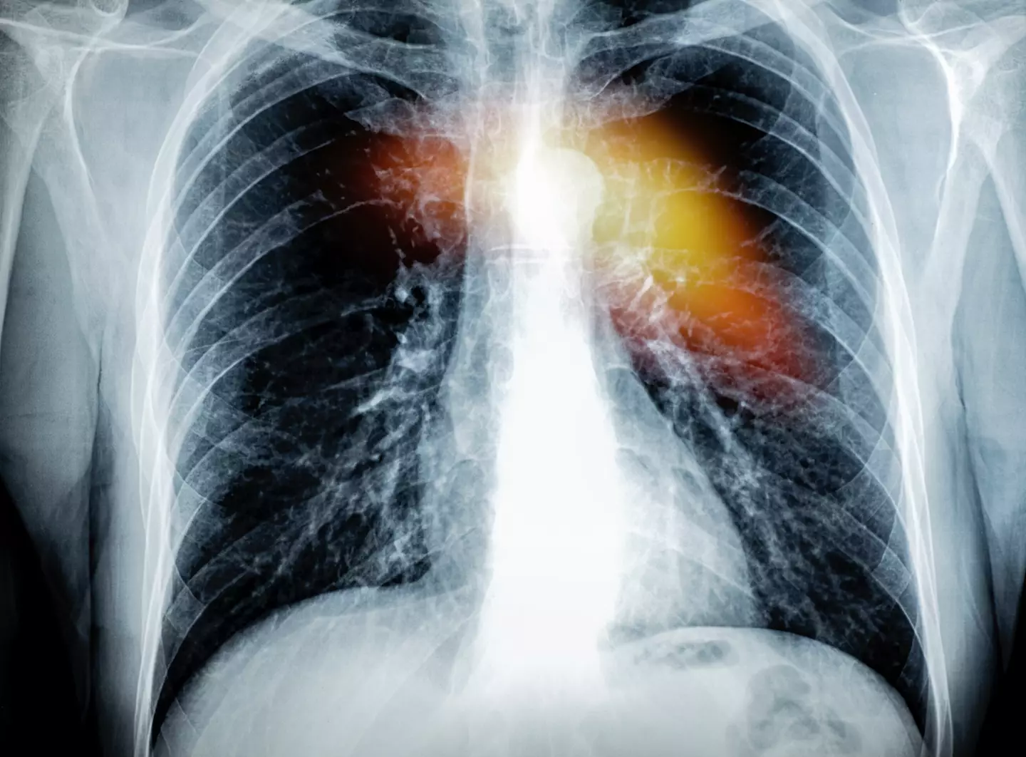 Women are more likely to suffer a 'silent heart attack' than men. ( Jose A. Bernat Bacete/Getty)