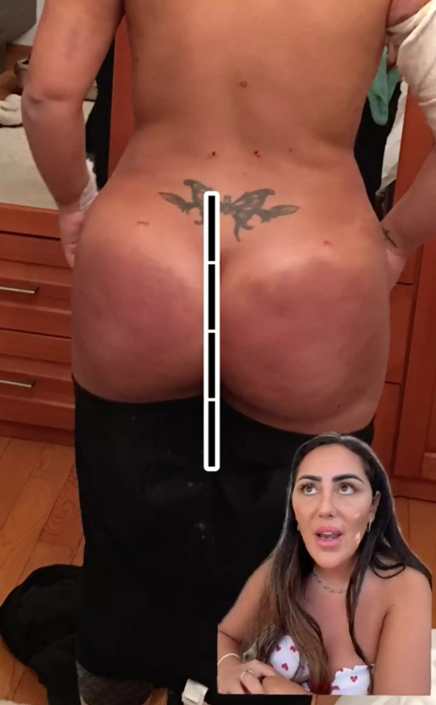 Sophie began suffering pain in her new bum.