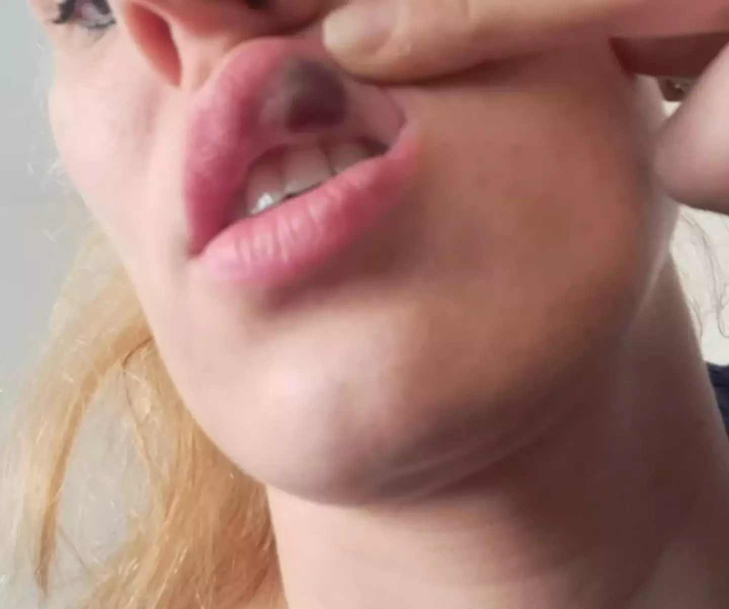 Edita's reaction to the lip filler was immediate. (Supplied)