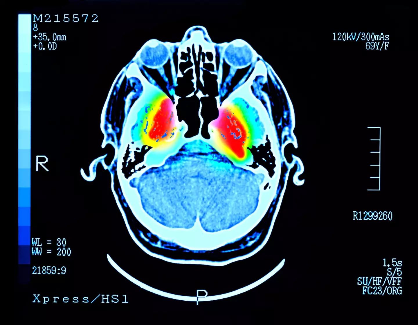 Gut toxins were found to trigger brain inflammation (Getty Stock Image)