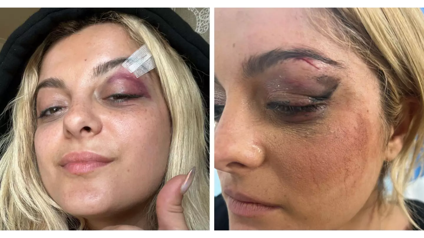 Fan arrested after throwing phone at singer Bebe Rexha's face leaving her needing stitches