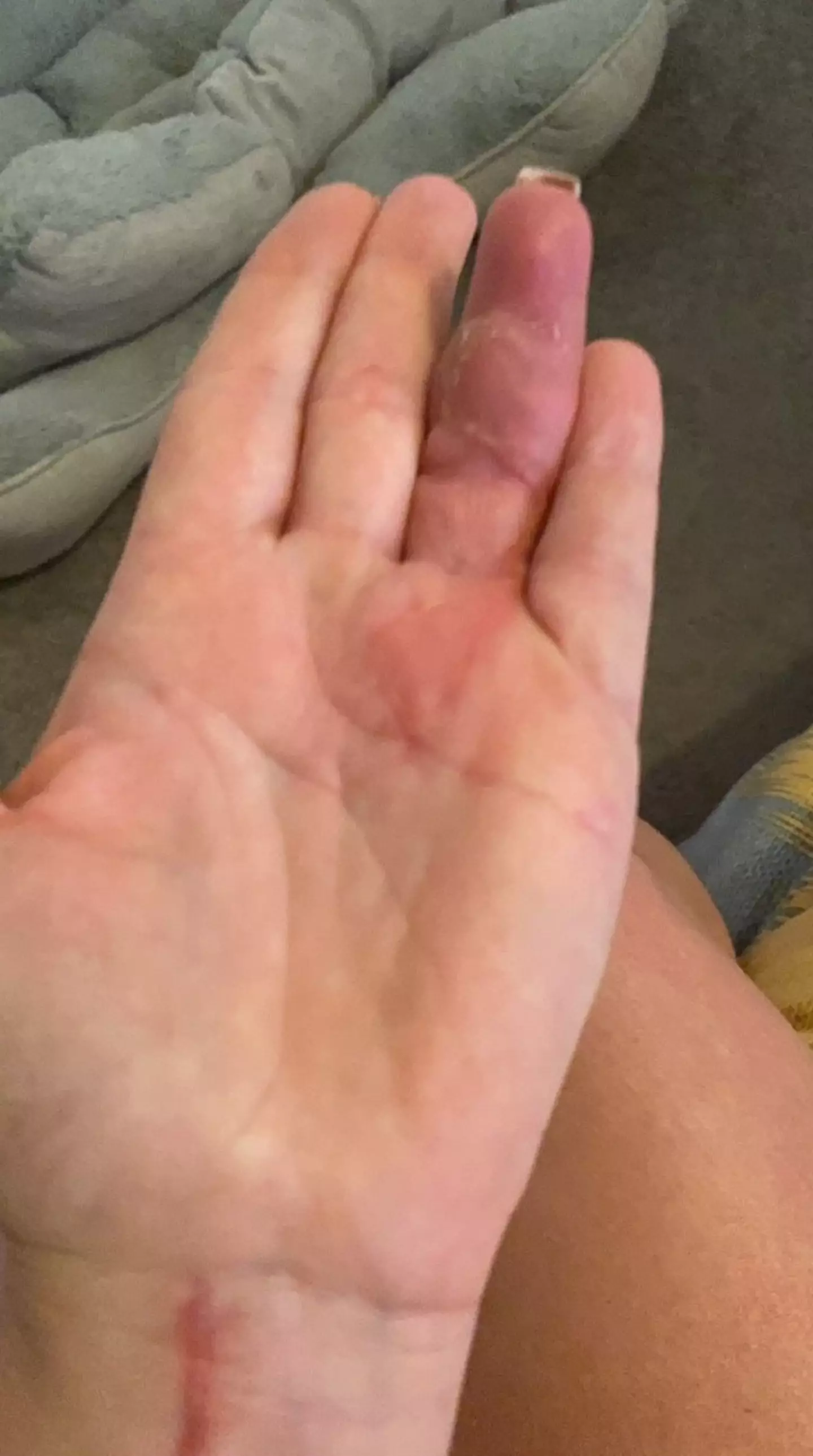 The finger was left badly swollen.