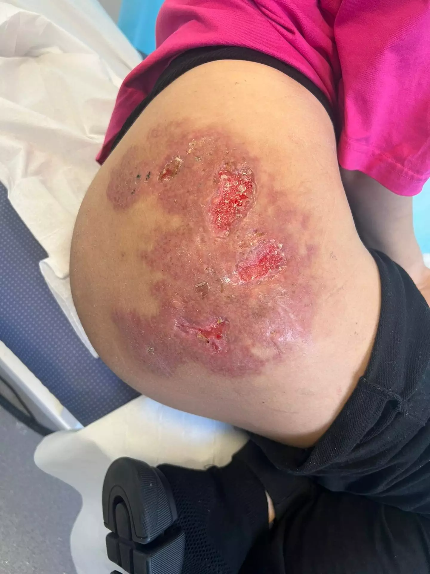 Her bum started going swollen and red.