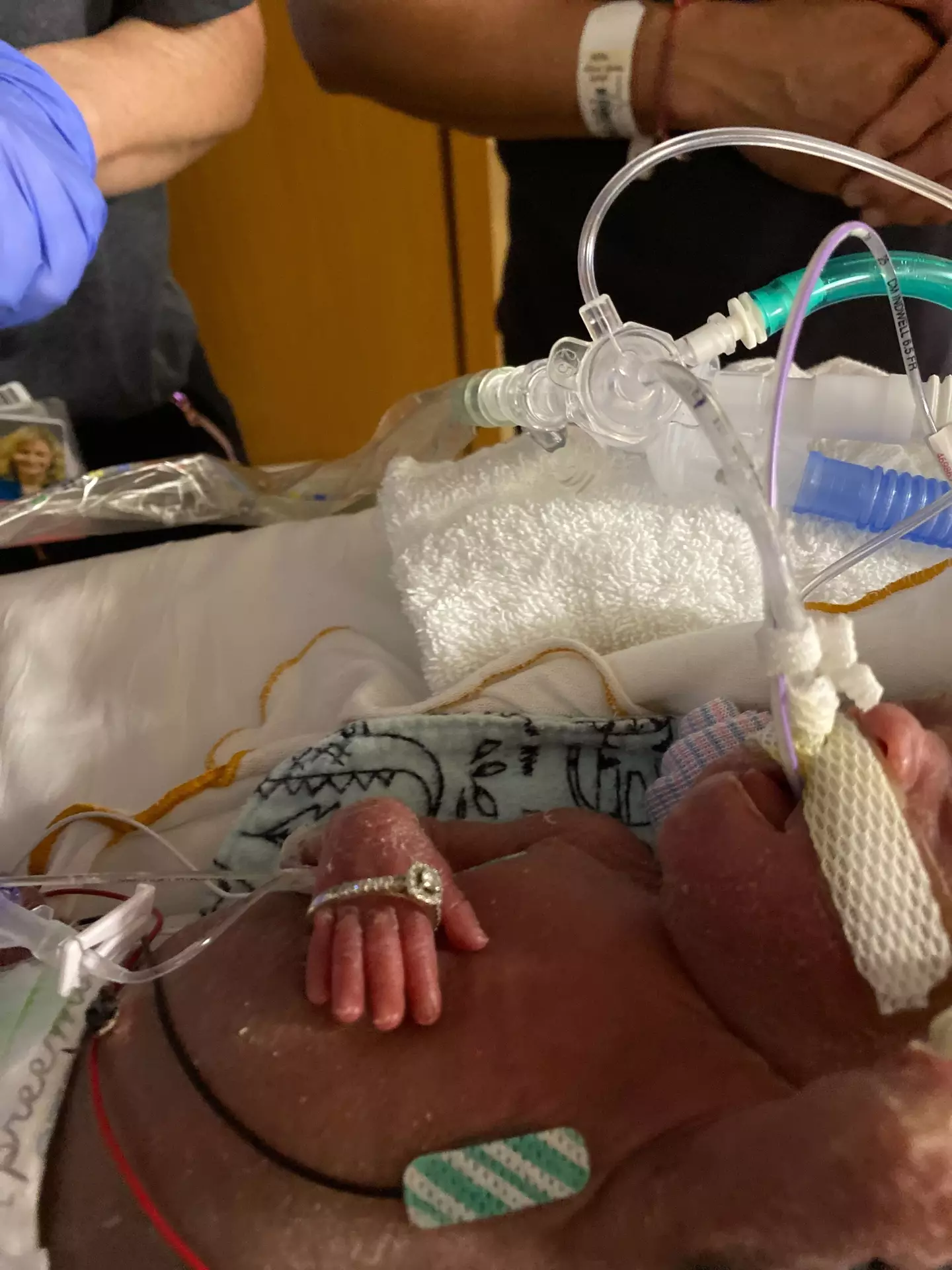 Eli James was born at 22 weeks.