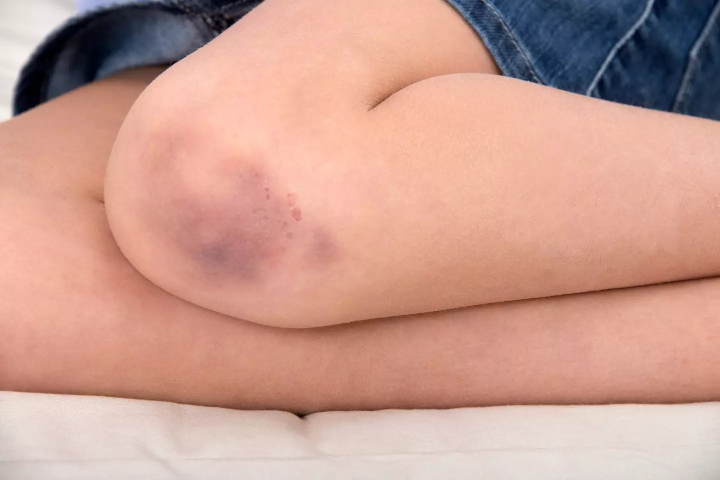 Bruising easily could be a sign of liver disease (Getty stock images)