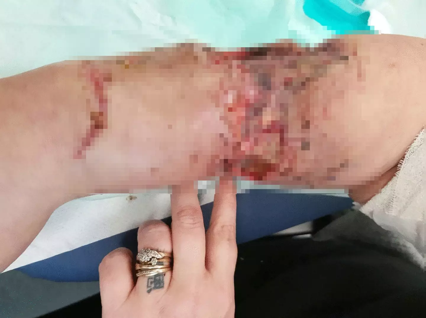 She was looking after her friend's kids when their pet Husky attacked her.