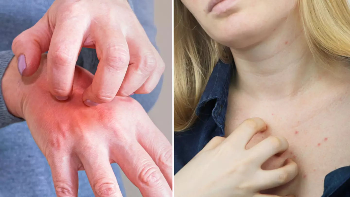 NHS advice on highly contagious skin disease after Brits issued warning over surge in cases