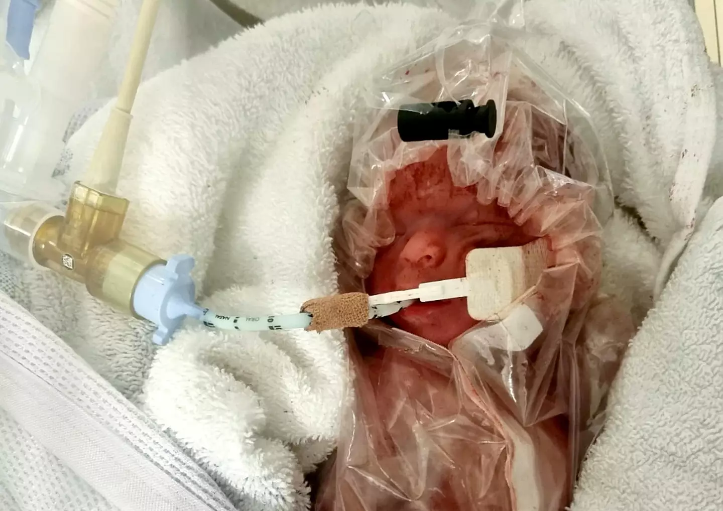 One of Britain's smallest babies has defied the odds and returned home after being born at 25 weeks.