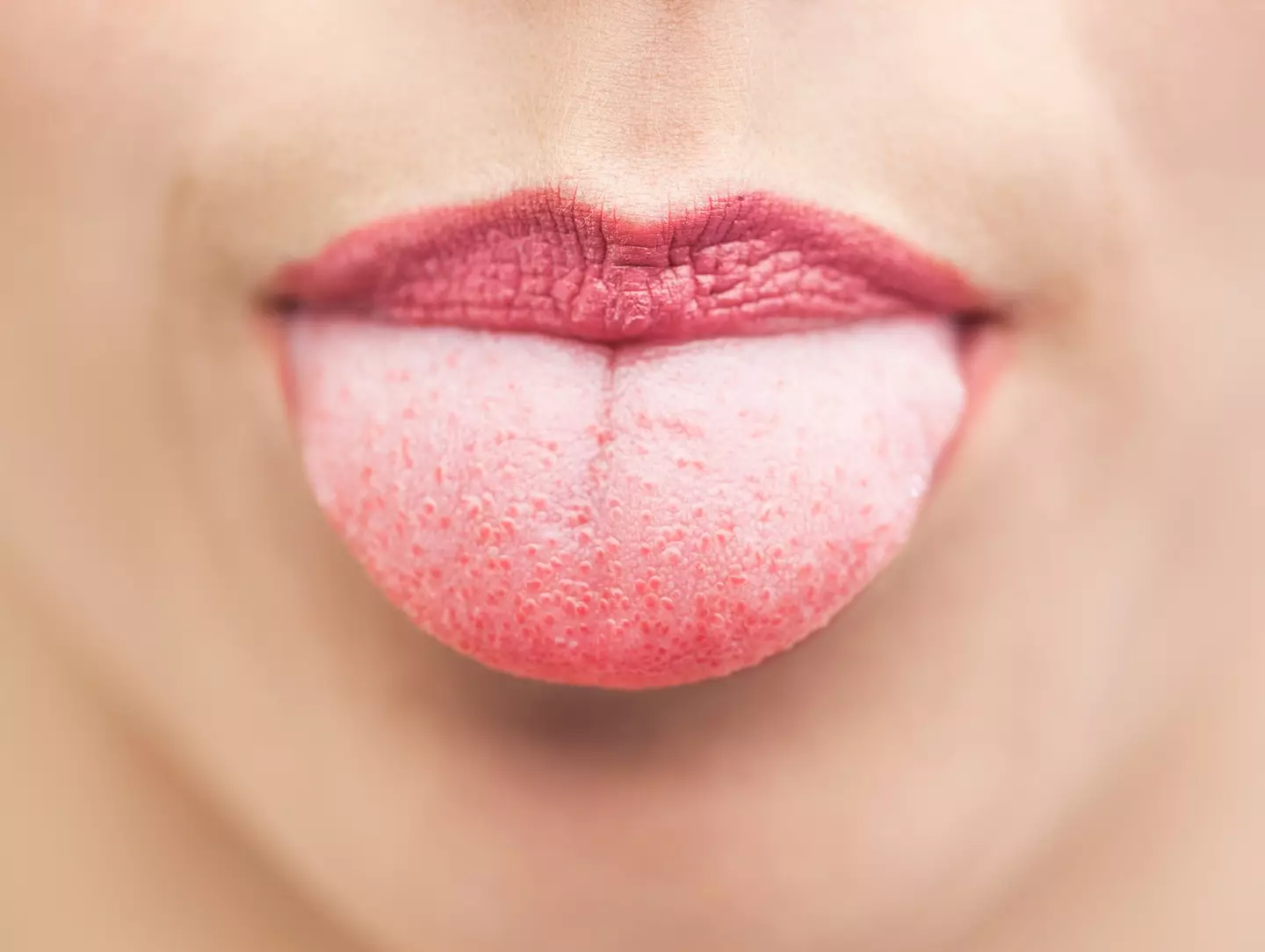 'Tongue pimples' are luckily not contagious (Wavebreakmedia Ltd / Getty Images)