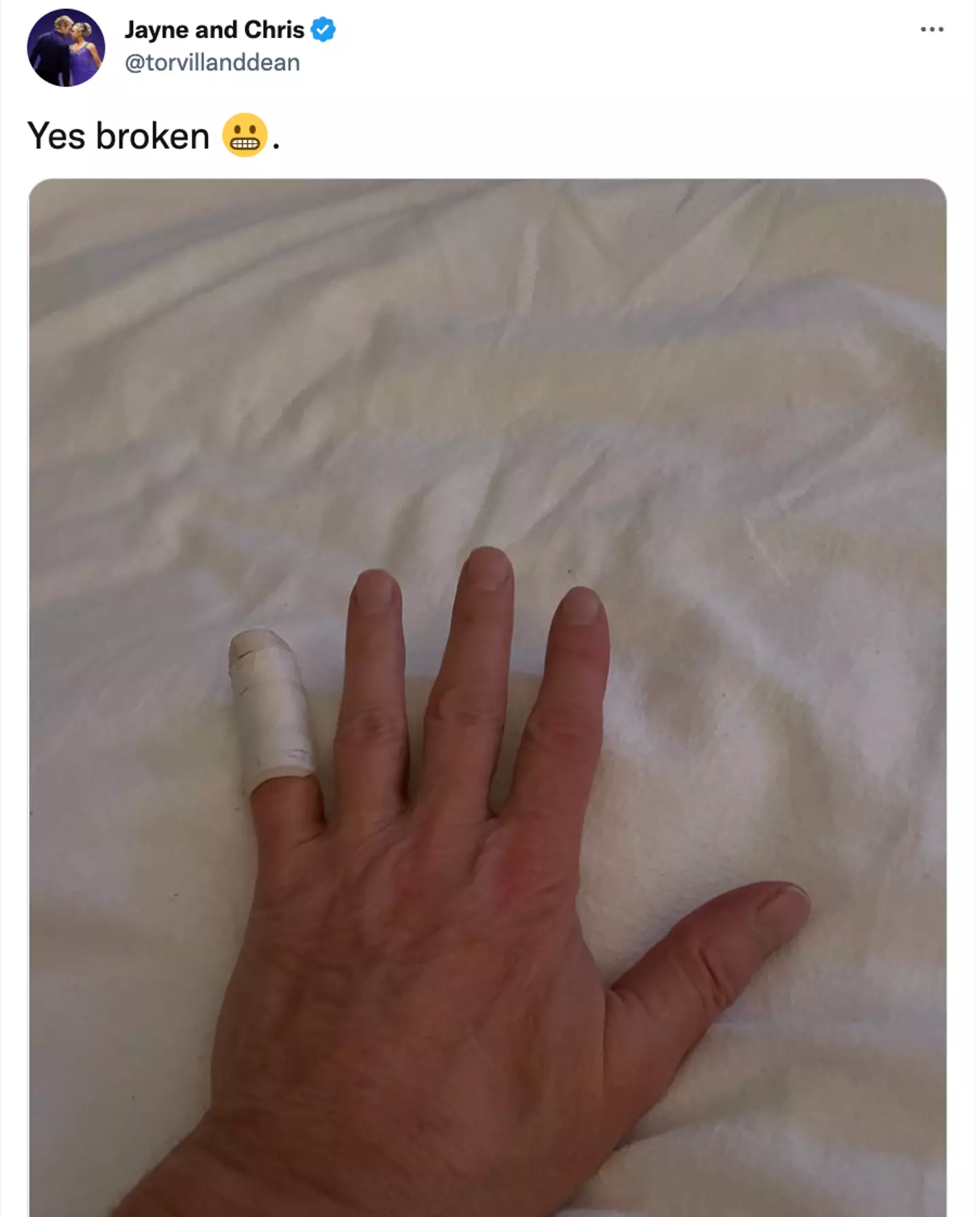Dean broke his finger in the unfortunate accident.