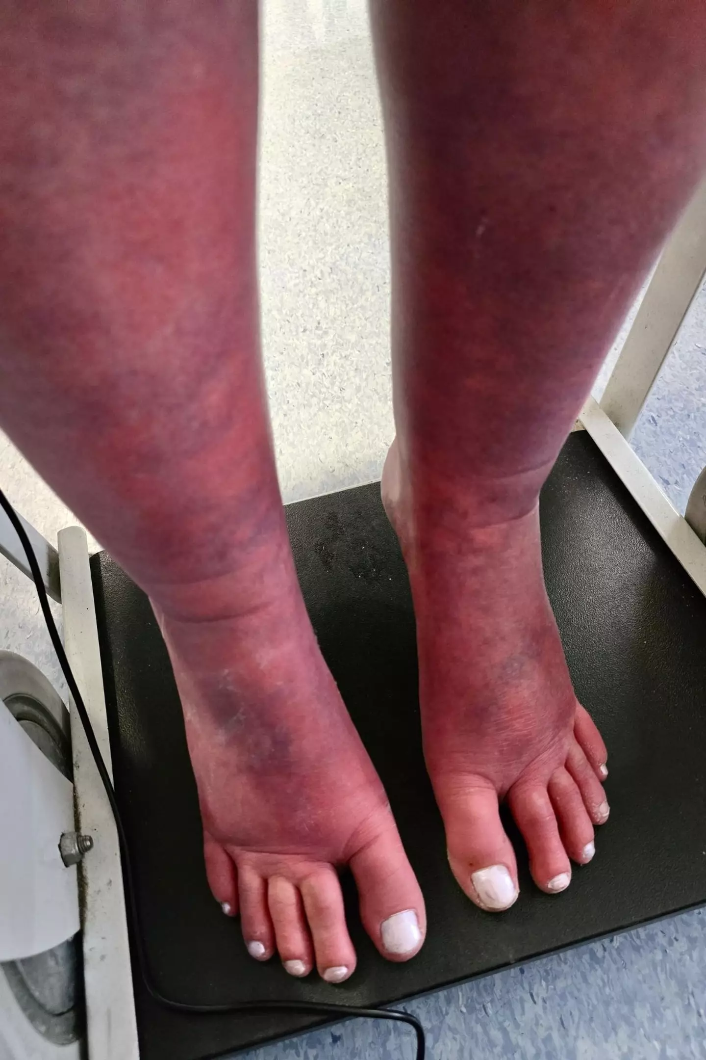 She was diagnosed with a rare disorder known as erythromelalgia (PA Real Life)
