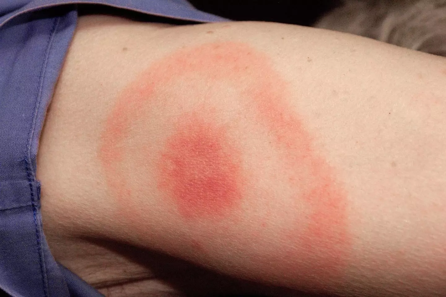 A rash is one of the symptoms (NHS)