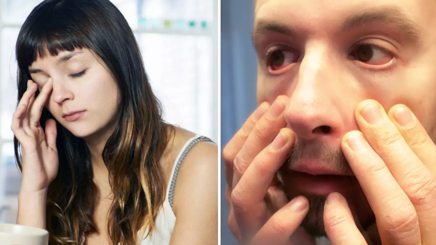 Dark circles under your eyes could signify a more serious issue than just tiredness