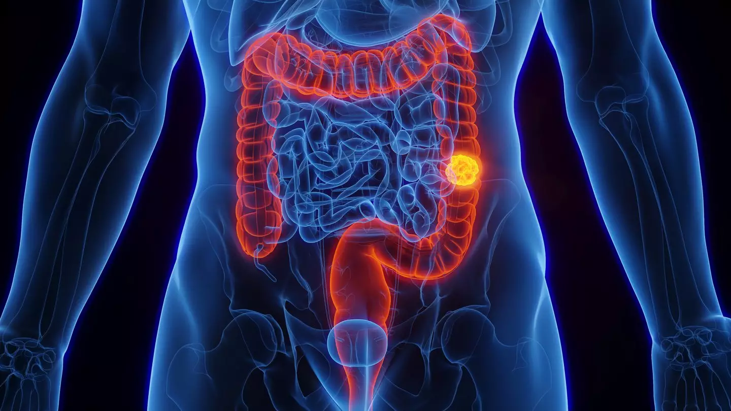Bowel movement changes are an early indicator of bowel cancer (Getty Stock Images)