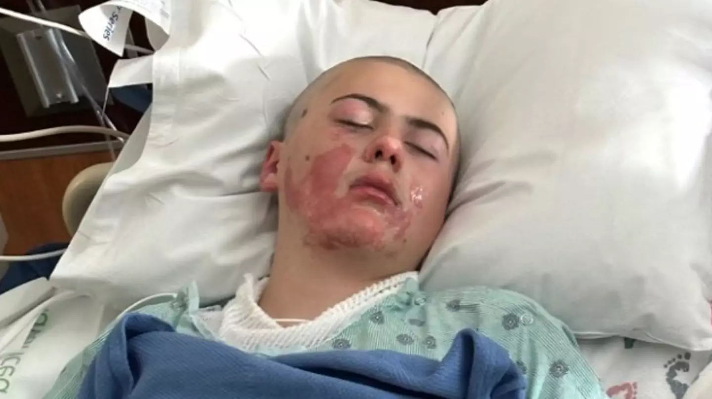 12-year-old boy’s skin ‘melted away’ after viral TikTok stunt went wrong