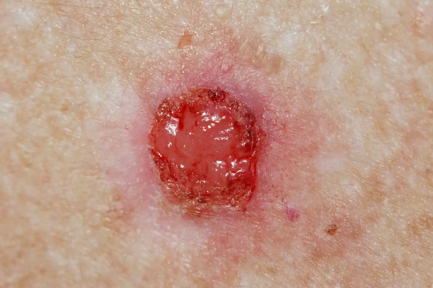 These sores can also appear as red lumps and can bleed.