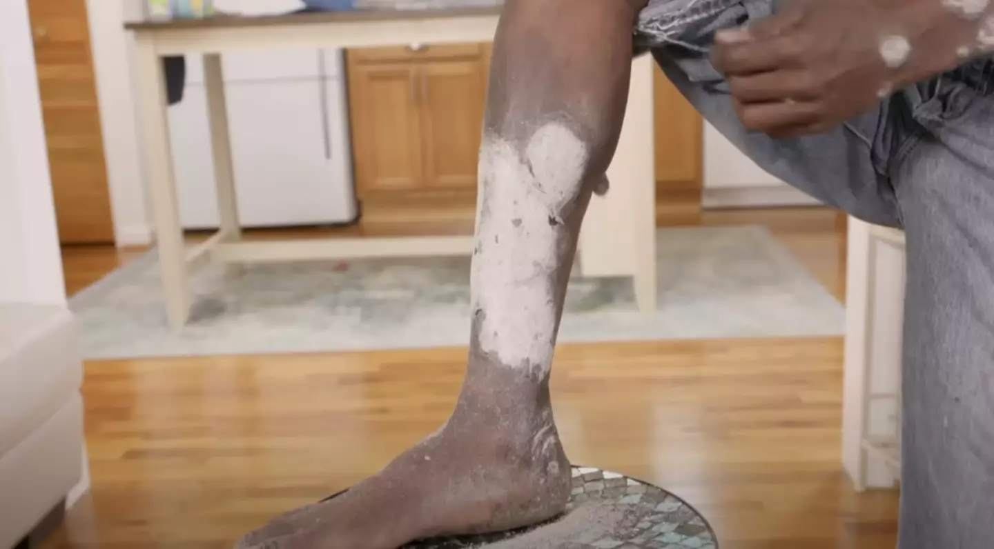 Even after being given cream, he still found nothing seemed to help ease the intense itching.