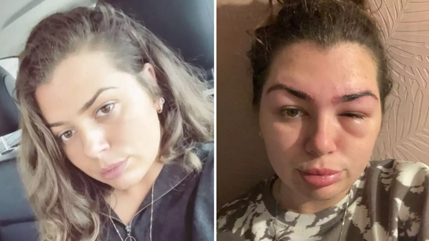 Woman left temporarily blind after salon ‘forgot to do allergy test on brow tint’