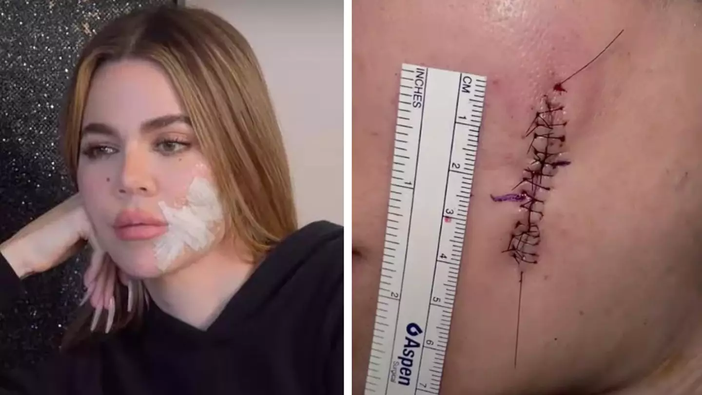 Khloe Kardashian reveals huge scar after having 'deadly' skin cancer removed