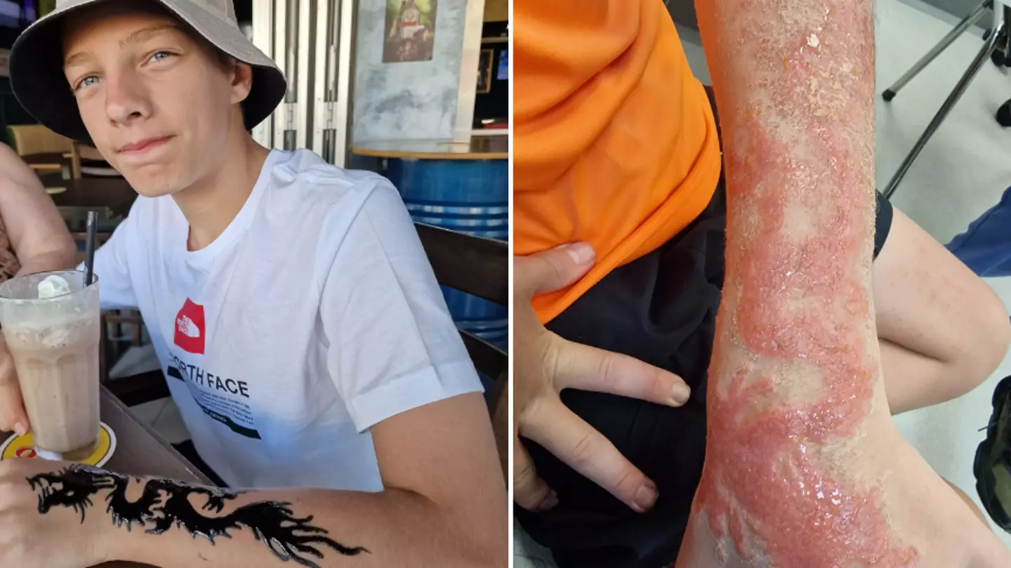 Mum claims holiday henna left son with 'weeping’ chemical burns