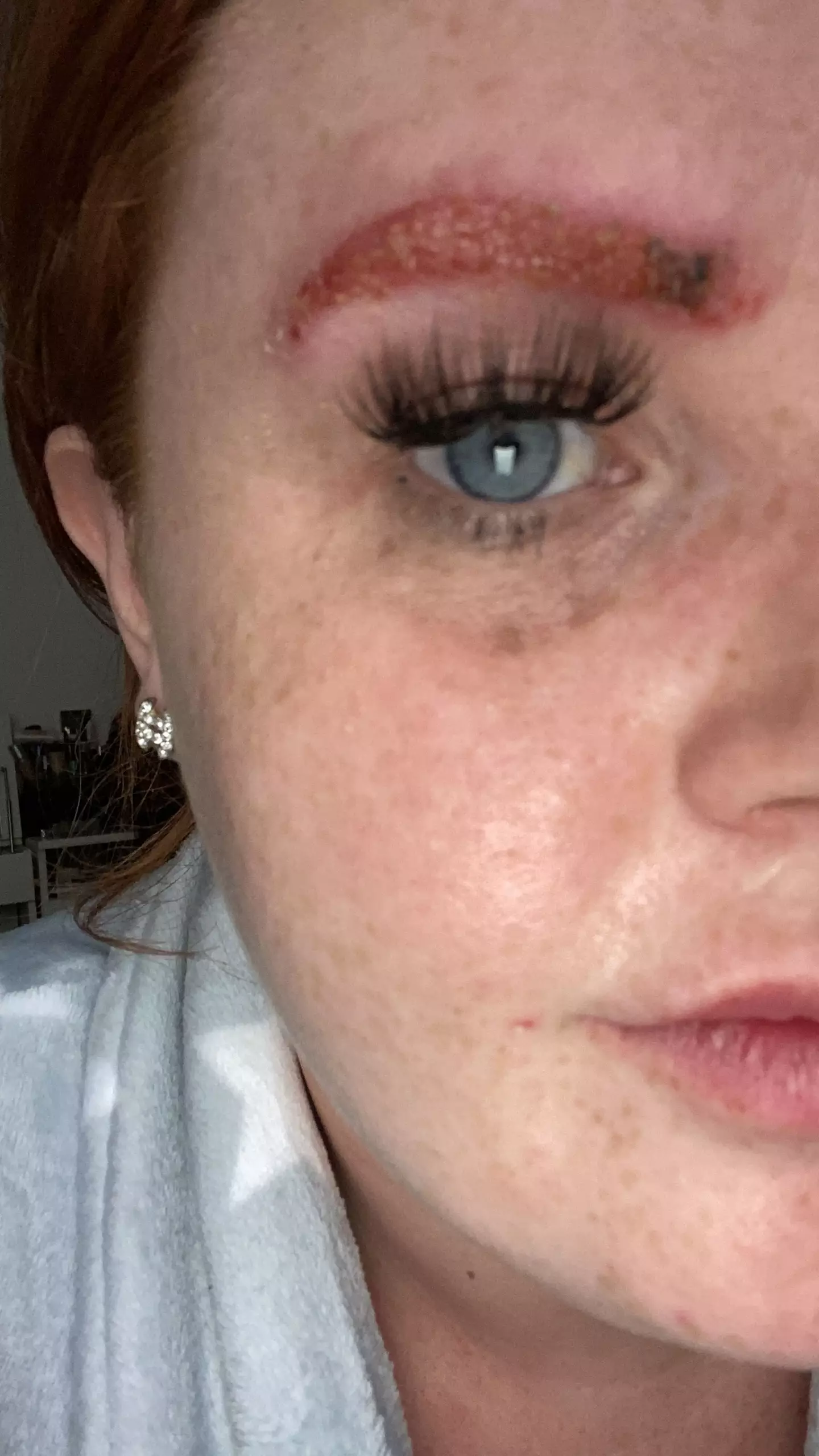 Michelle suffered from an allergic reaction.