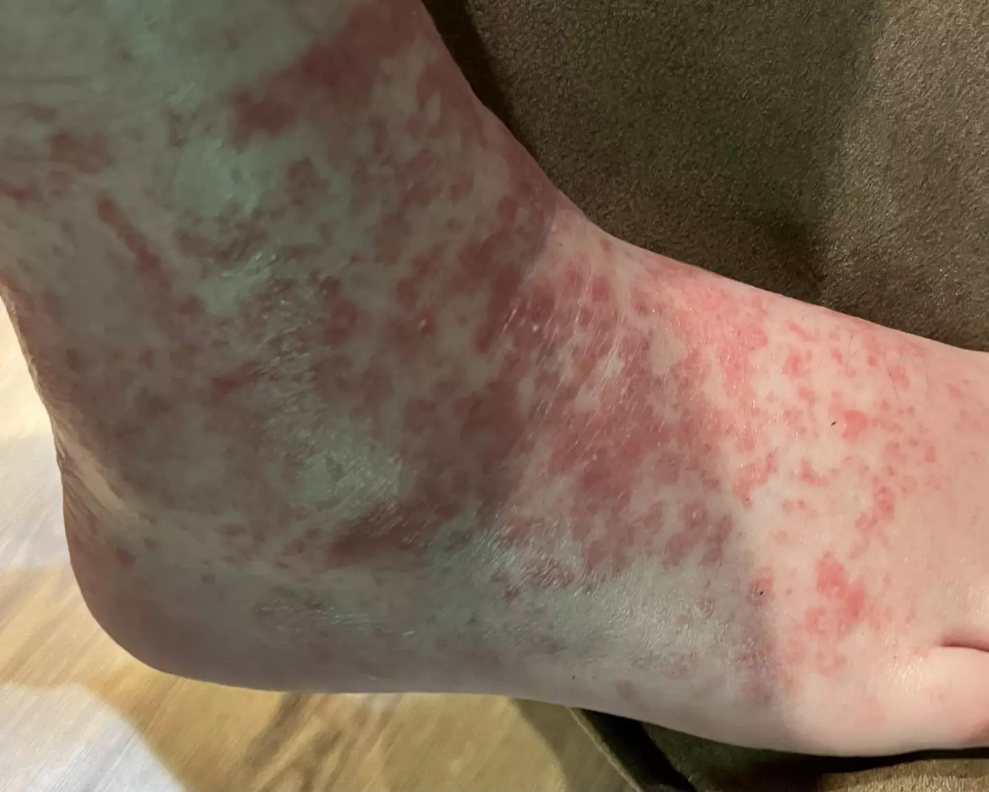 The mum was told that her rash was likely either an allergic reaction to something in the shoes or - the worst case scenario - scabies.