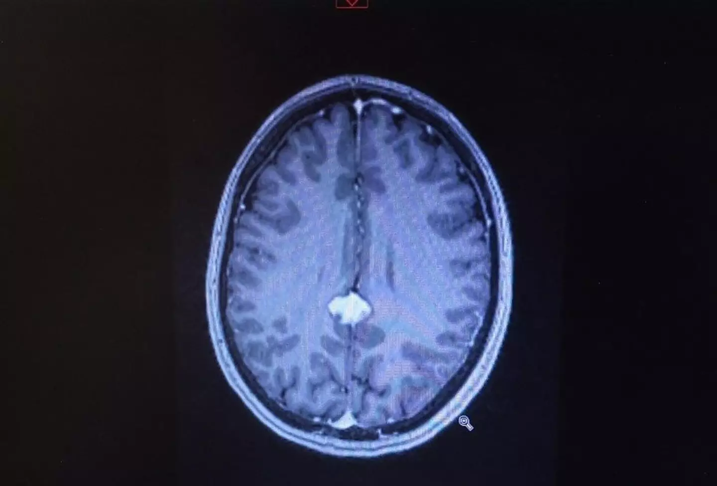 April's tumour has since shrunk (SWNS)