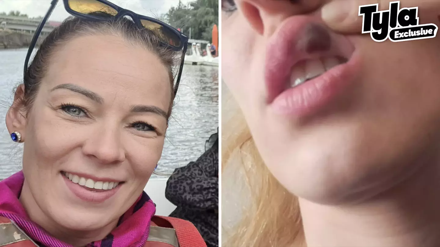 Woman who had 'rare' reaction to lip-filler had no idea she was about to get life-changing diagnosis