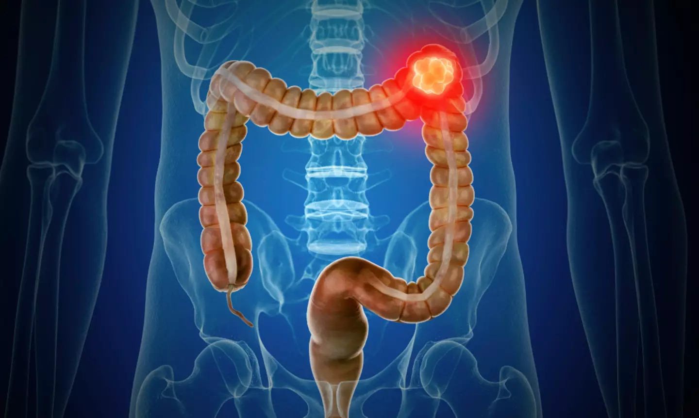 Bowel cancer cases are at an all-time high (Getty Stock Image)