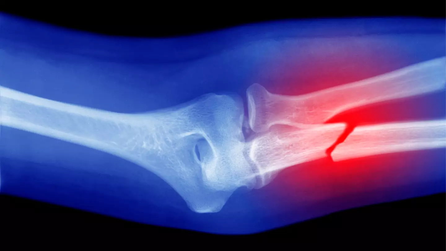 Eerie conspiracy theory you might want to pay attention to if you’ve never broken a bone in your life