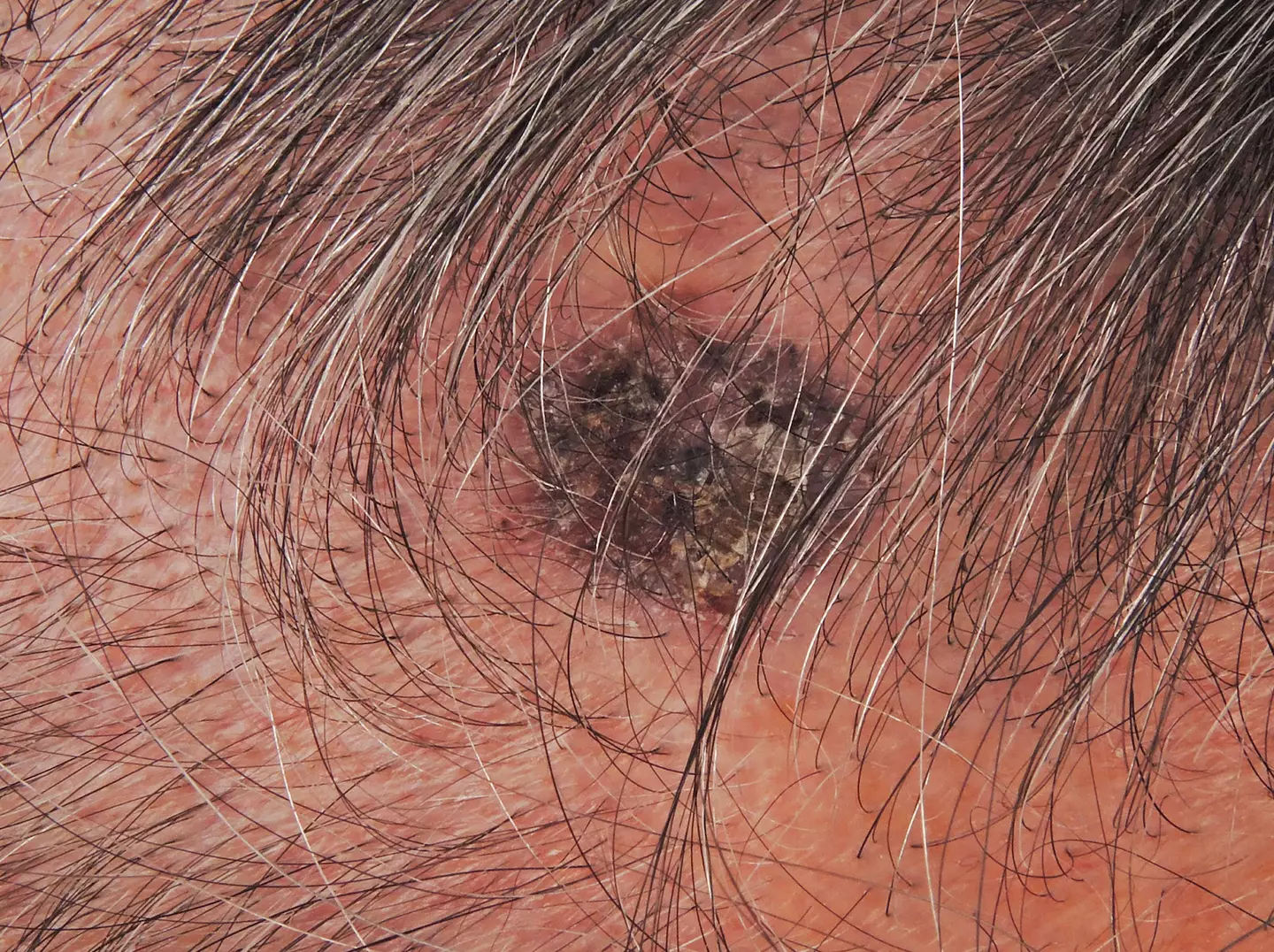 This type of skin cancer can appear as a freckle.