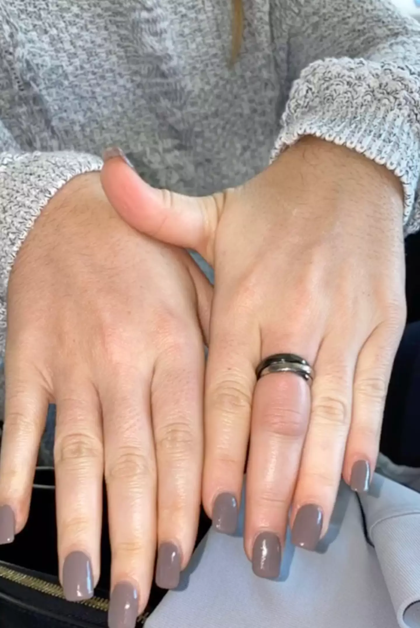 Her finger had nearly doubled in size.