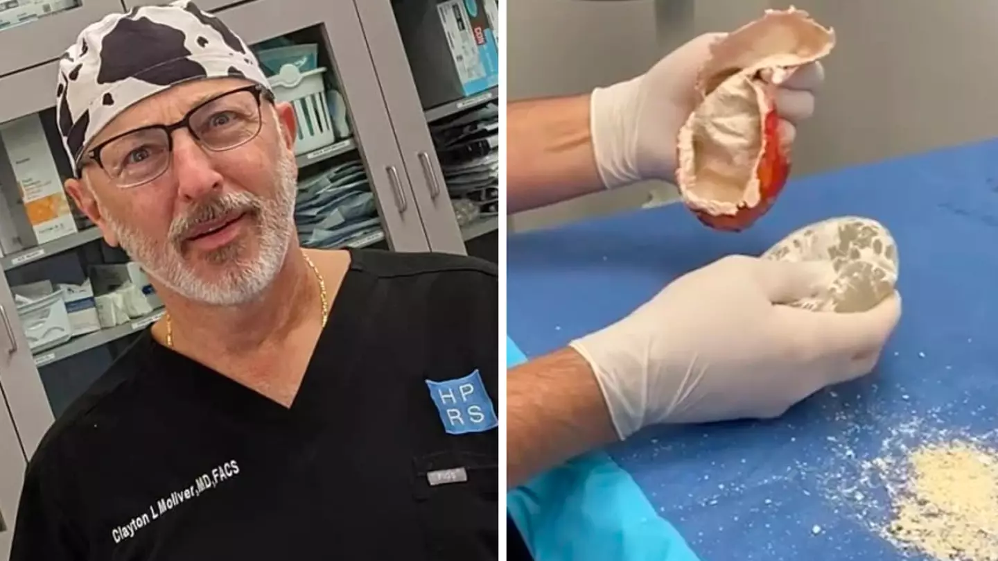 Plastic surgeon shares shocking result of old breast implant left inside body