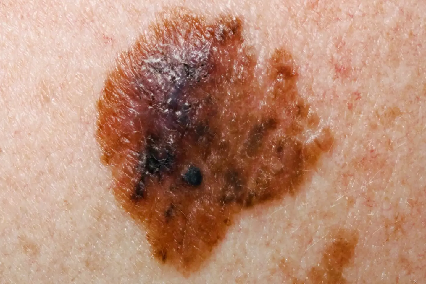 Moles without clear edges should be checked out. (NHS)